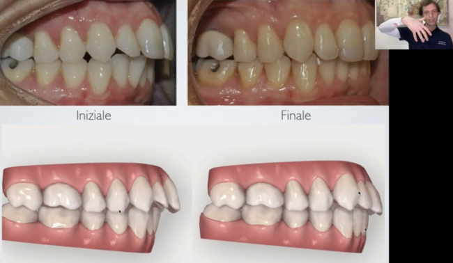 Torque ant Controllo torque anteriori
